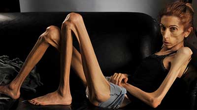 Recognizing Anorexia Symptoms