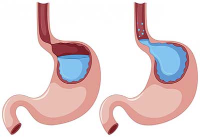 Understanding Gastroesophageal Reflux Disease Symptoms