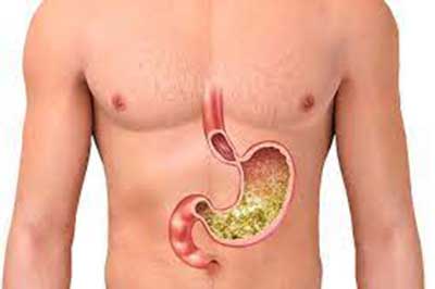 Understanding Gastroesophageal Reflux Disease Symptoms