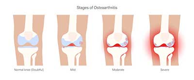 Understanding Osteoarthritis Symptoms